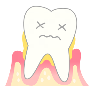 periodontosis_mechanism04