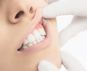Denti bianchi visita alle gengive arrossate