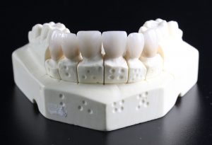 tooth-replacement-759929_1920