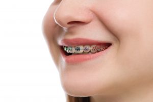 Closeup multicolored Braces on Teeth. Beautiful Female Smile por