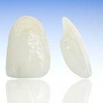 e-maxセラミッククラウンで白すぎない天然の歯に似た差し歯を作る審美歯科治療
