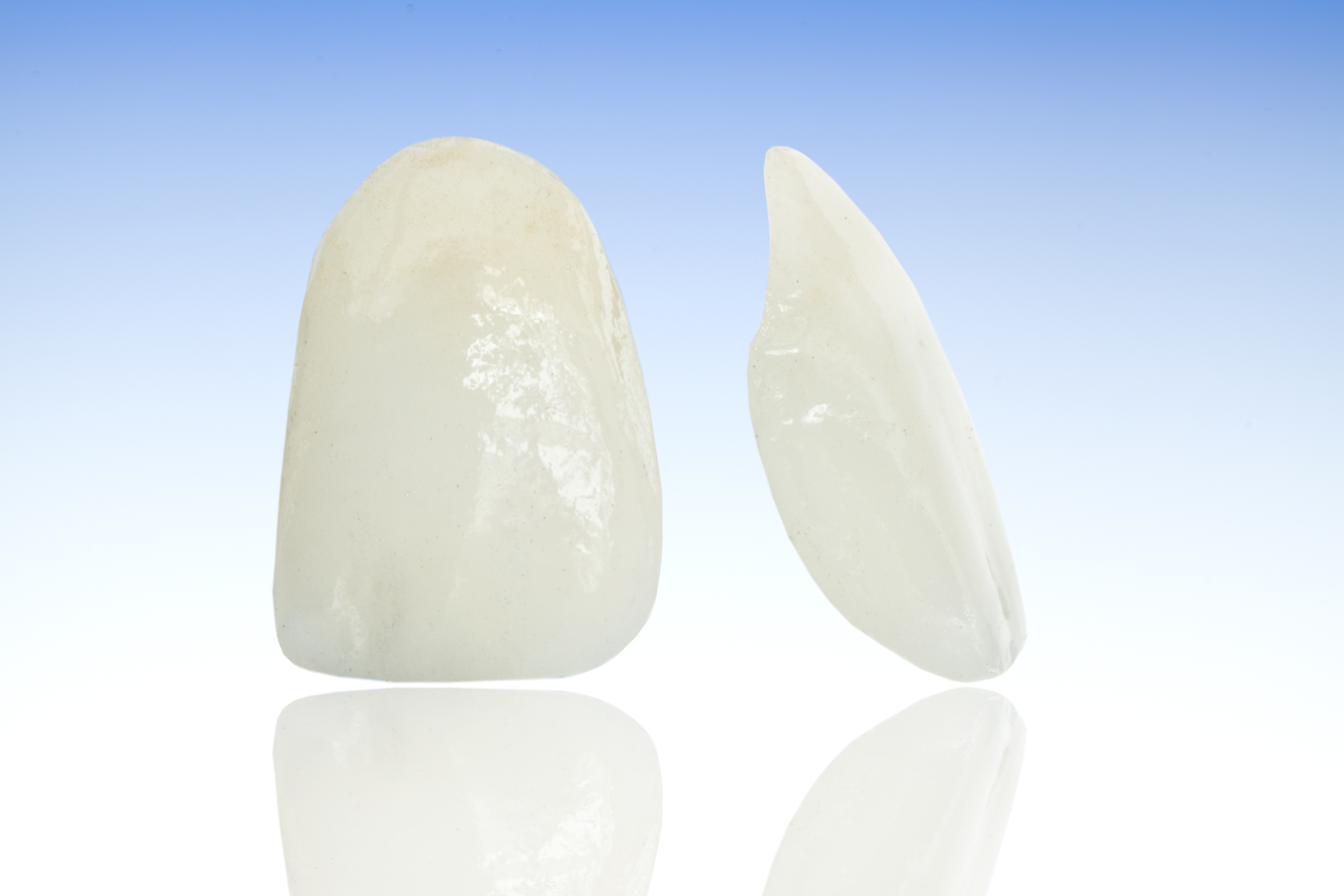 E-maxセラミッククラウンで白すぎない天然の歯に似た差し歯を作る審美歯科治療