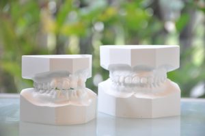 歯科平行模型